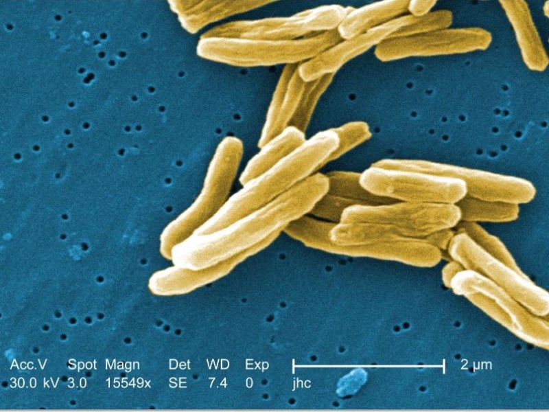 Tuberculosis