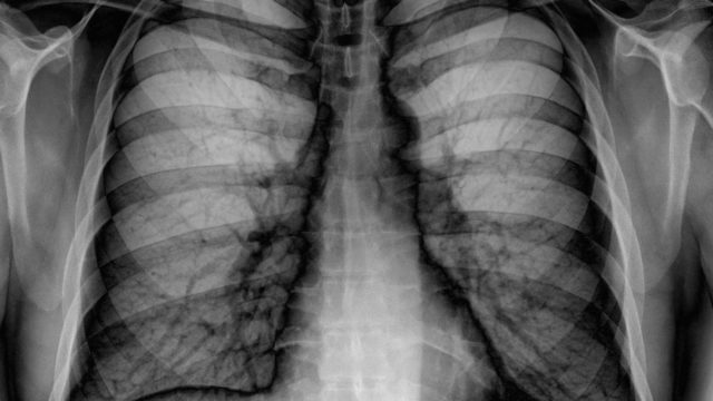 Chest x-ray Tuberculosis case